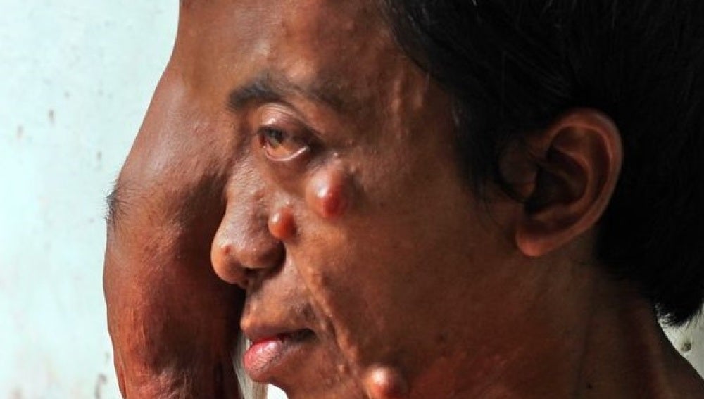 Herdi, un hombre de Indonesia con un tumor en el ojo
