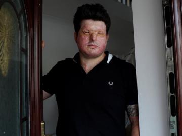 Andreas Christopheros, víctima de un ataque con ácido en Reino Unido Andreas Christopheros, víctima de un ataque con ácido en Reino Unido