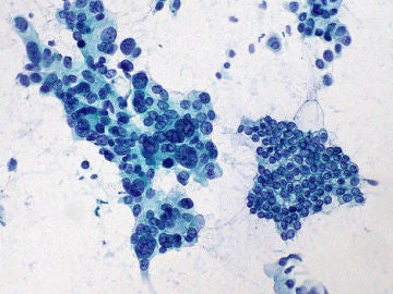 El estudio de un gen abre una nueva puerta a la prevencion del cancer de pancreas El estudio de un gen abre una nueva puerta a la prevencion del cancer de pancreas