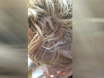 Joven con quemaduras de segundo grado en la cabeza Joven con quemaduras de segundo grado en la cabeza