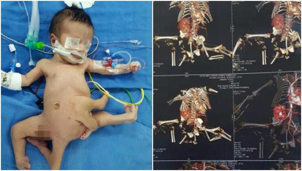 Un bebé nace con ocho extremidades y es operado con éxito en un hospital en la India