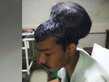 Imagen del hombre operado en La India de un tumor de casi dos kilos Imagen del hombre operado en La India de un tumor de casi dos kilos