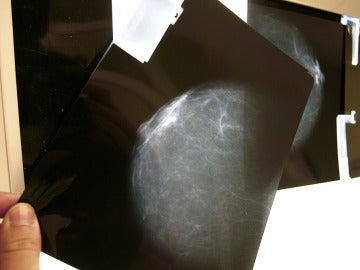 Ensayo clínico de vacunas contra el cáncer de mama Ensayo clínico de vacunas contra el cáncer de mama