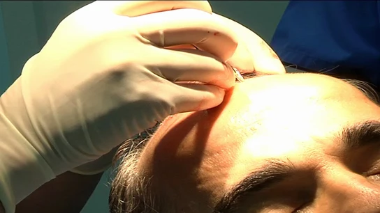 Trasplante capilar Trasplante capilar