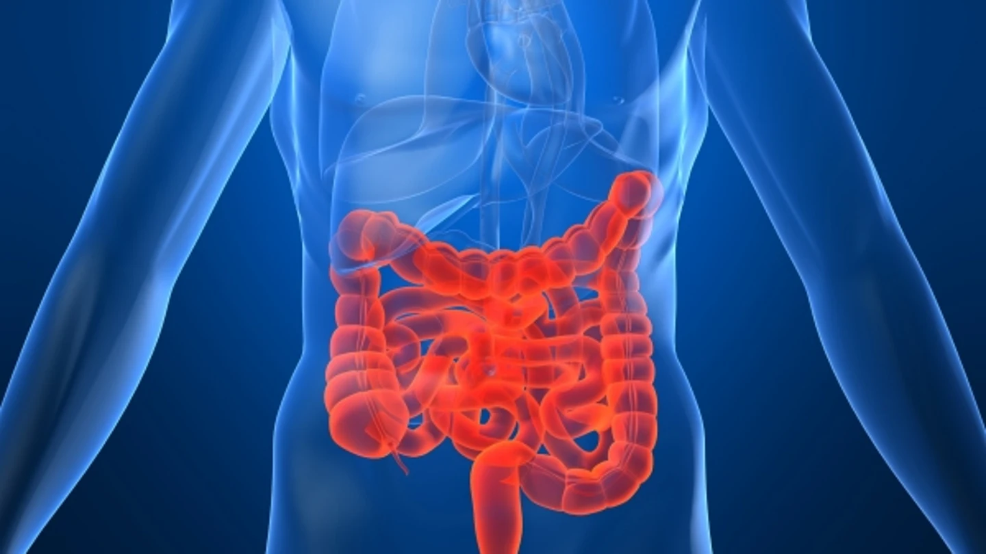 Cáncer de colon Cáncer de colon