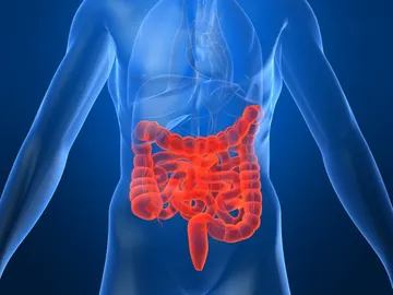 Cáncer de colon Cáncer de colon