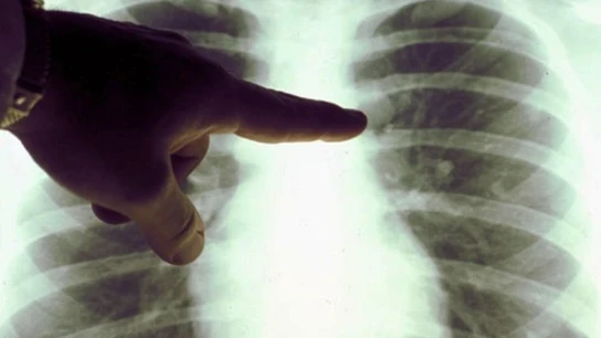 Un oncólogo examina la radiografía de unos pulmones Un oncólogo examina la radiografía de unos pulmones