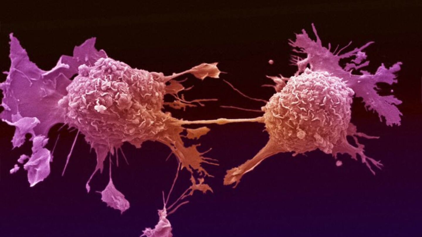 C&eacute;lulas de c&aacute;ncer de pulm&oacute;n