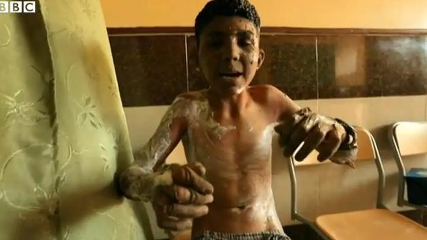 Niño que ha sufrido un ataque en Siria Niño que ha sufrido un ataque en Siria