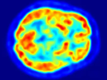 Un cerebro a través de un PET Un cerebro a través de un PET