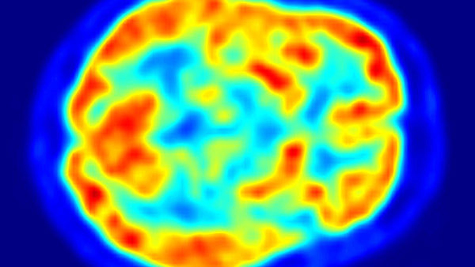 Un cerebro a través de un PET