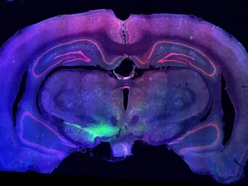 El trasplante de neuronas dopaminérgicas podría revertir el daño que el párkinson hace en estas células El trasplante de neuronas dopaminérgicas podría revertir el daño que el párkinson hace en estas células