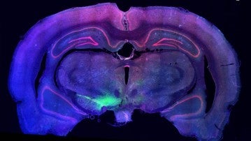 El trasplante de neuronas dopaminérgicas podría revertir el daño que el párkinson hace en estas células