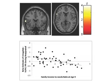 Escáneres cerebrales que prueban los efectos de la pobreza infantil en el cerebro Escáneres cerebrales que prueban los efectos de la pobreza infantil en el cerebro