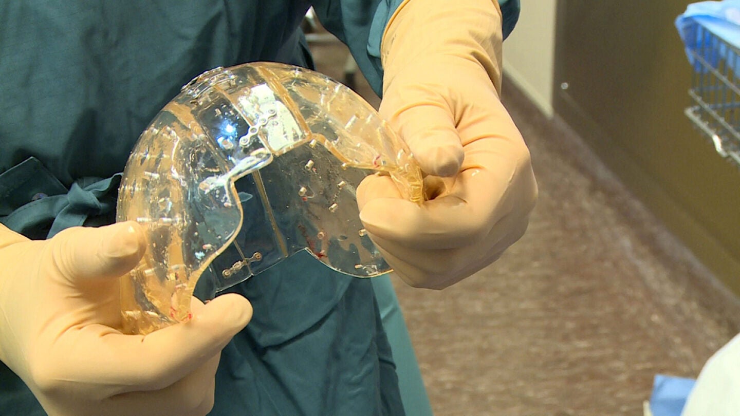 Implantan un cr&aacute;neo elaborado con una impresora 3D a una holandesa de 22 a&ntilde;os