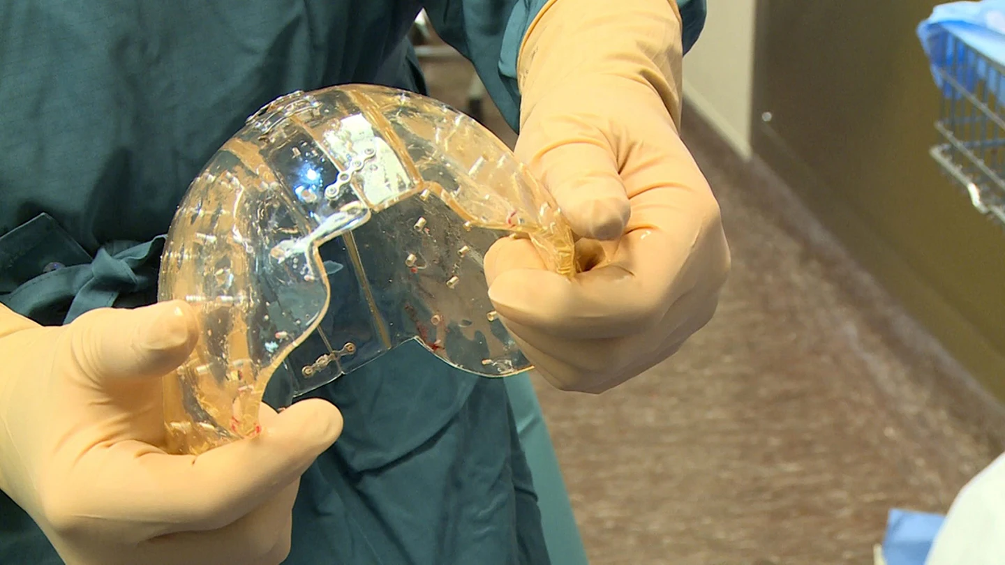 Implantan un cráneo elaborado con una impresora 3D a una holandesa de 22 años Implantan un cráneo elaborado con una impresora 3D a una holandesa de 22 años