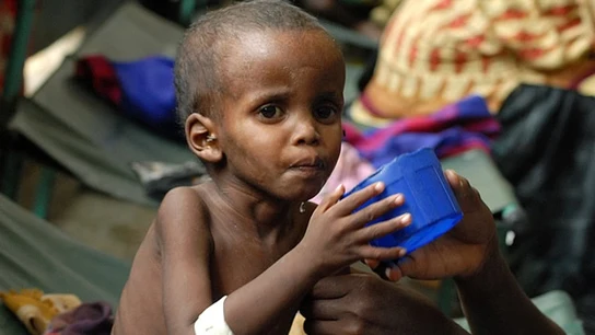 Niño afectado por la crisis alimentaria en Somalia Niño afectado por la crisis alimentaria en Somalia
