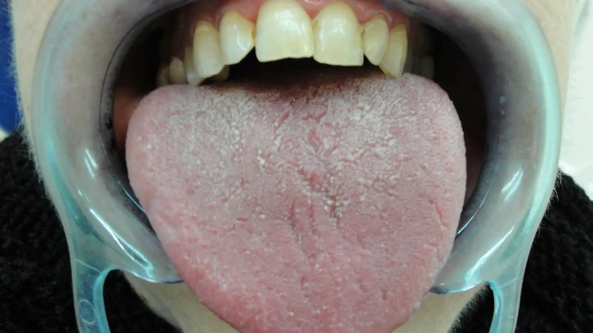 Aspecto de la lengua de una paciente con