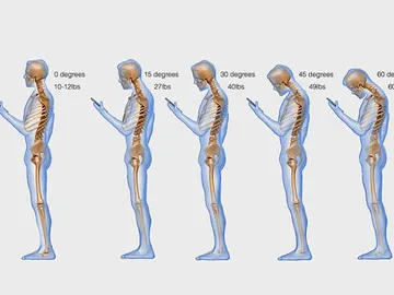 Text Neck o dolor cervical por consultar el móvil Text Neck o dolor cervical por consultar el móvil