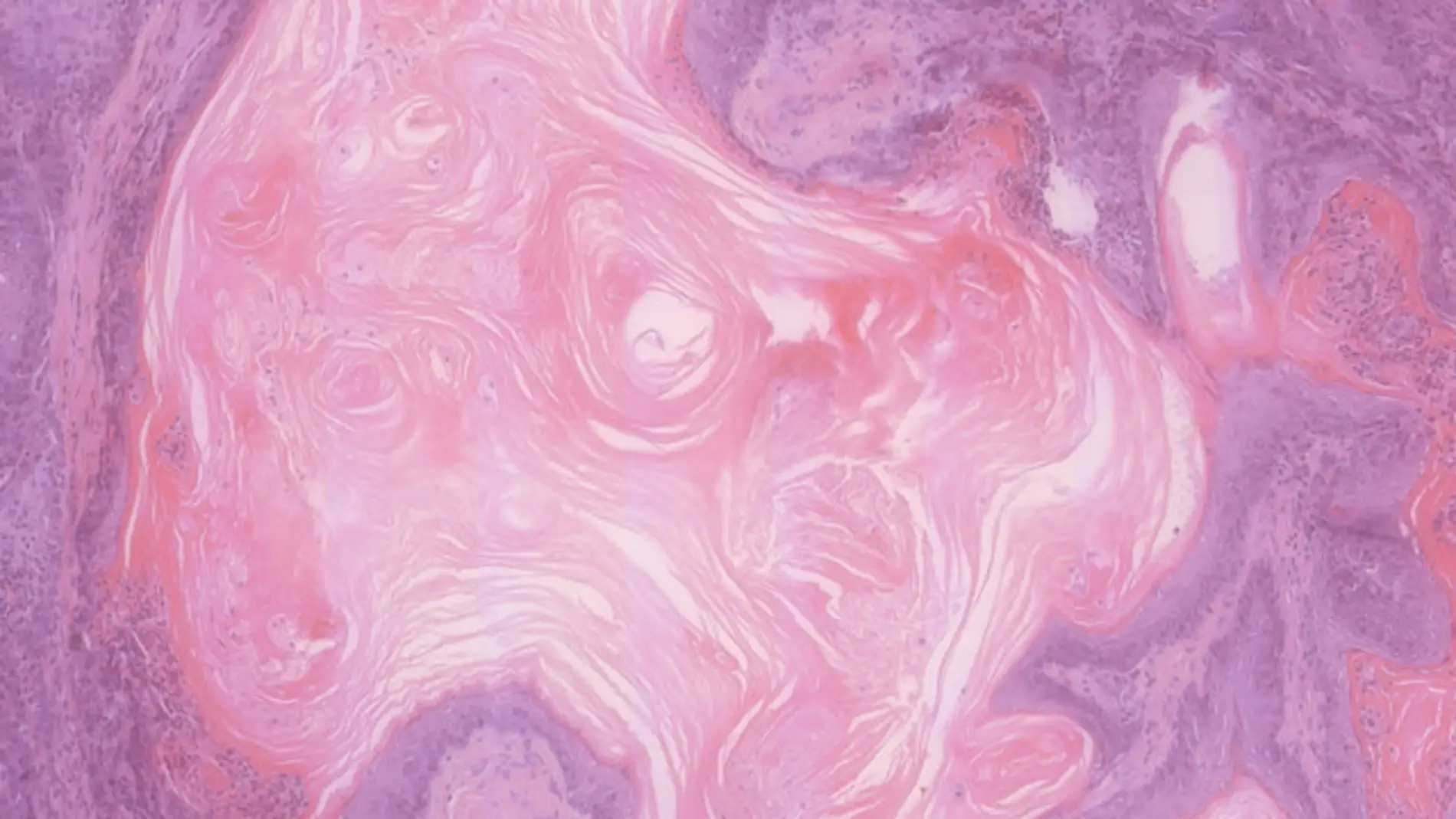 imagen CNIO carcinoma vejiga