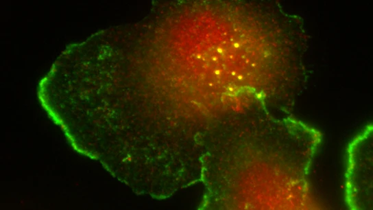Células tumorales humanas de cáncer de m Células tumorales humanas de cáncer de m