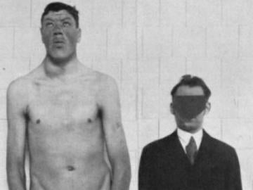 Los rasgos faciales de Rainer, a la izquierda, denotan gigantismo 