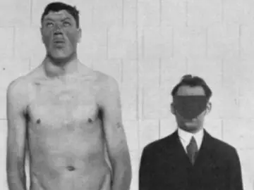 Los rasgos faciales de Rainer, a la izquierda, denotan gigantismo Los rasgos faciales de Rainer, a la izquierda, denotan gigantismo