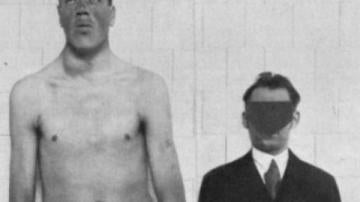 Los rasgos faciales de Rainer, a la izquierda, denotan gigantismo
