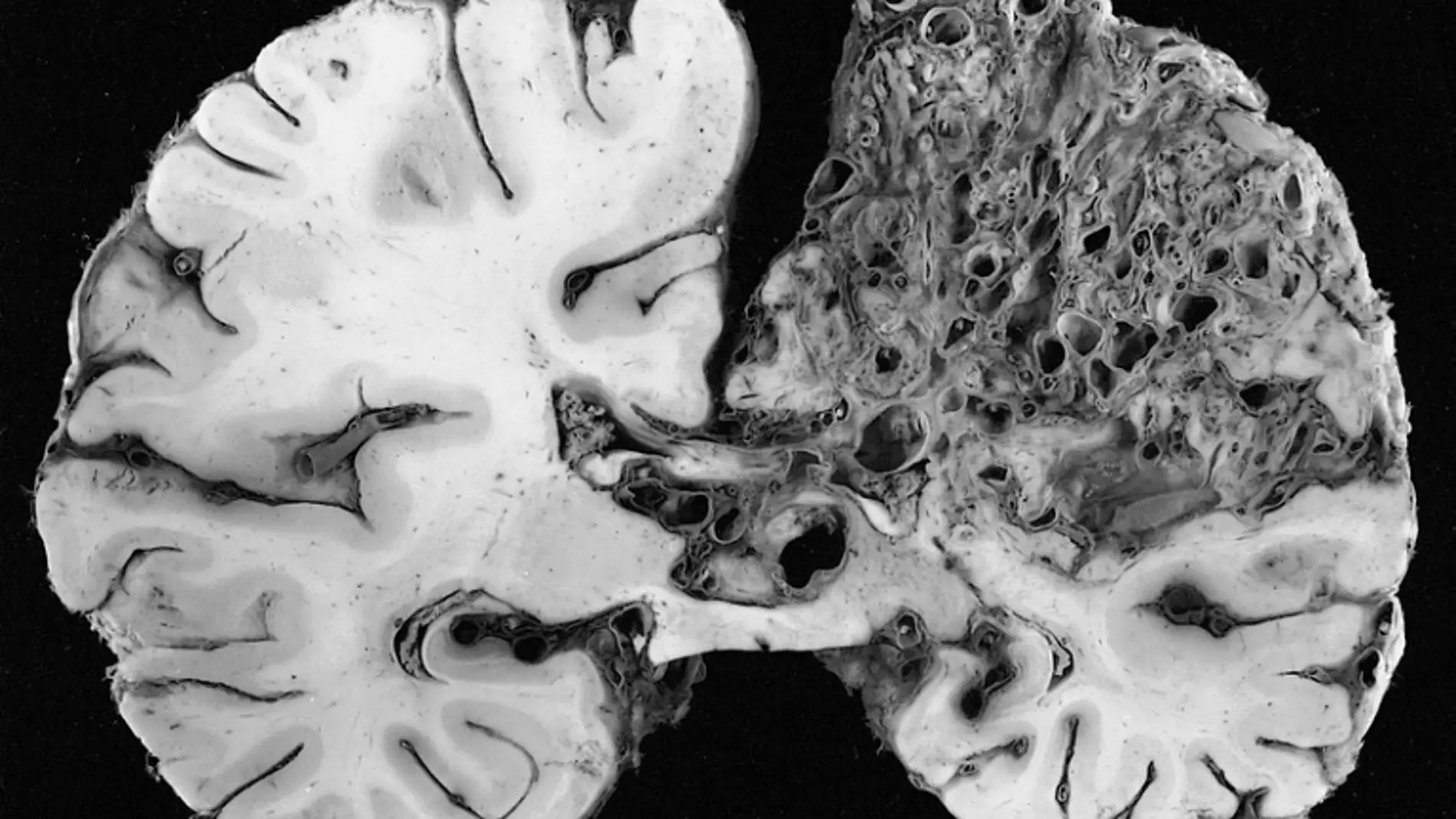 Deformación arteriovenosa en el hemisfer