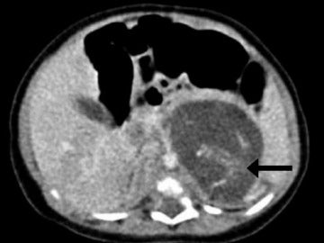 Tomografia computarizada mostrando la espina dorsal de uno de los dos "fetos"
