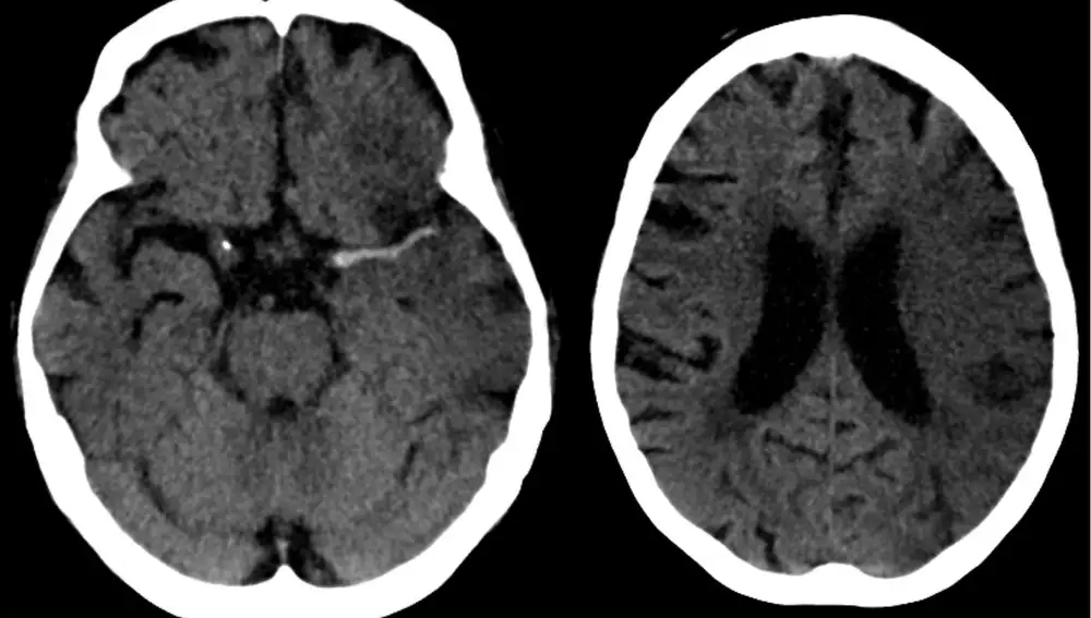 Ictus en arteria cerebral media (izda) y evolución a las 7 horas (dcha). Ictus en arteria cerebral media (izda) y evolución a las 7 horas (dcha).