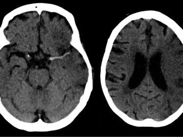 Ictus en arteria cerebral media (izda) y evolución a las 7 horas (dcha). 