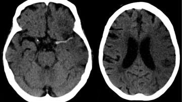 Ictus en arteria cerebral media (izda) y evolución a las 7 horas (dcha).