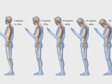 Text Neck o dolor cervical por consultar el móvil Text Neck o dolor cervical por consultar el móvil
