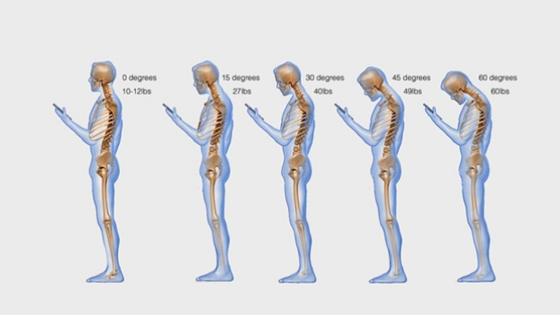 Text Neck o dolor cervical por consultar el móvil
