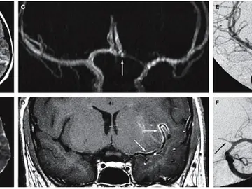 Paciente de 18 años con infarto y vasculitis cerebral producida por la cocaína Paciente de 18 años con infarto y vasculitis cerebral producida por la cocaína