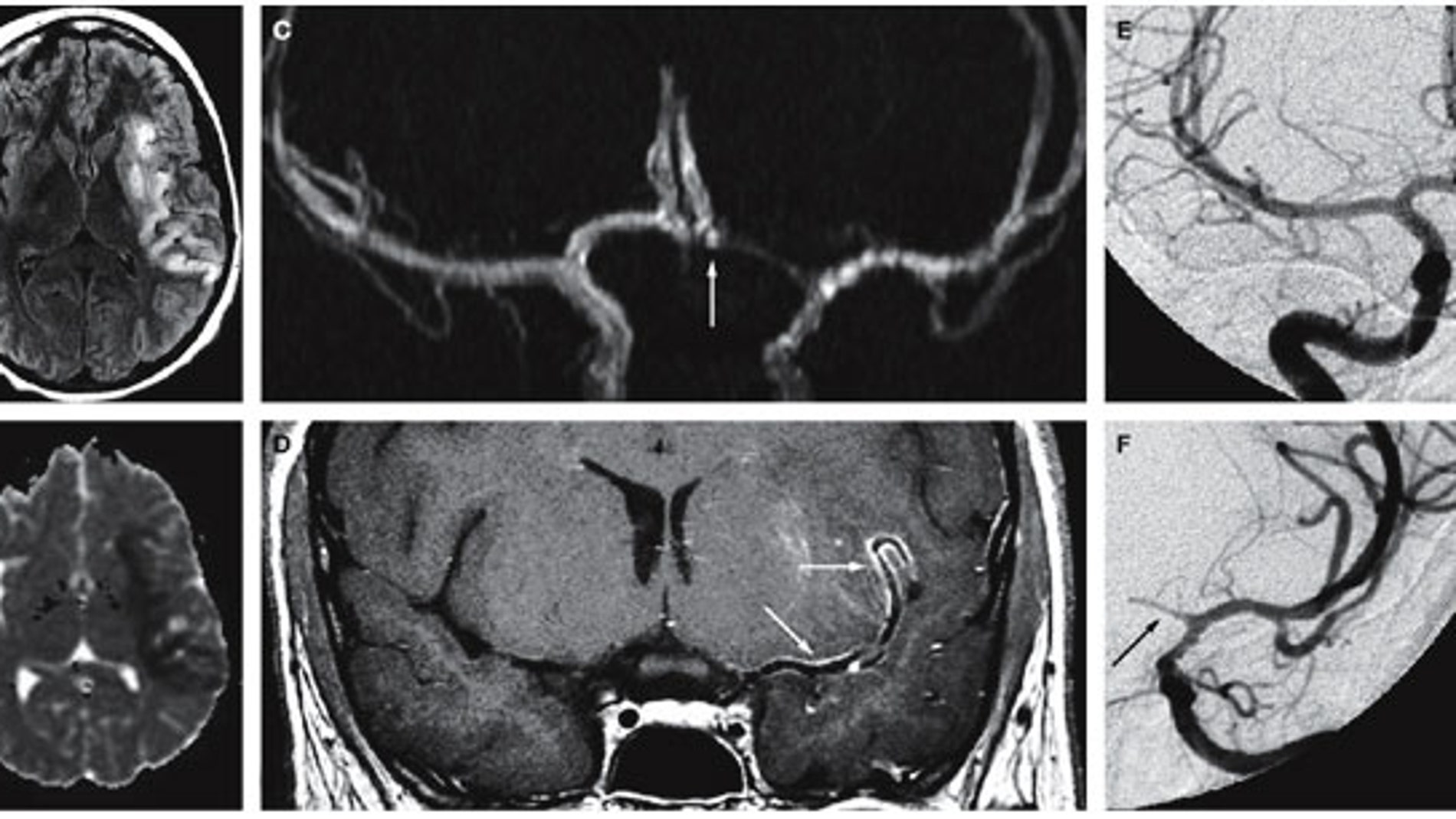 Paciente de 18 años con infarto y vasculitis cerebral producida por la cocaína