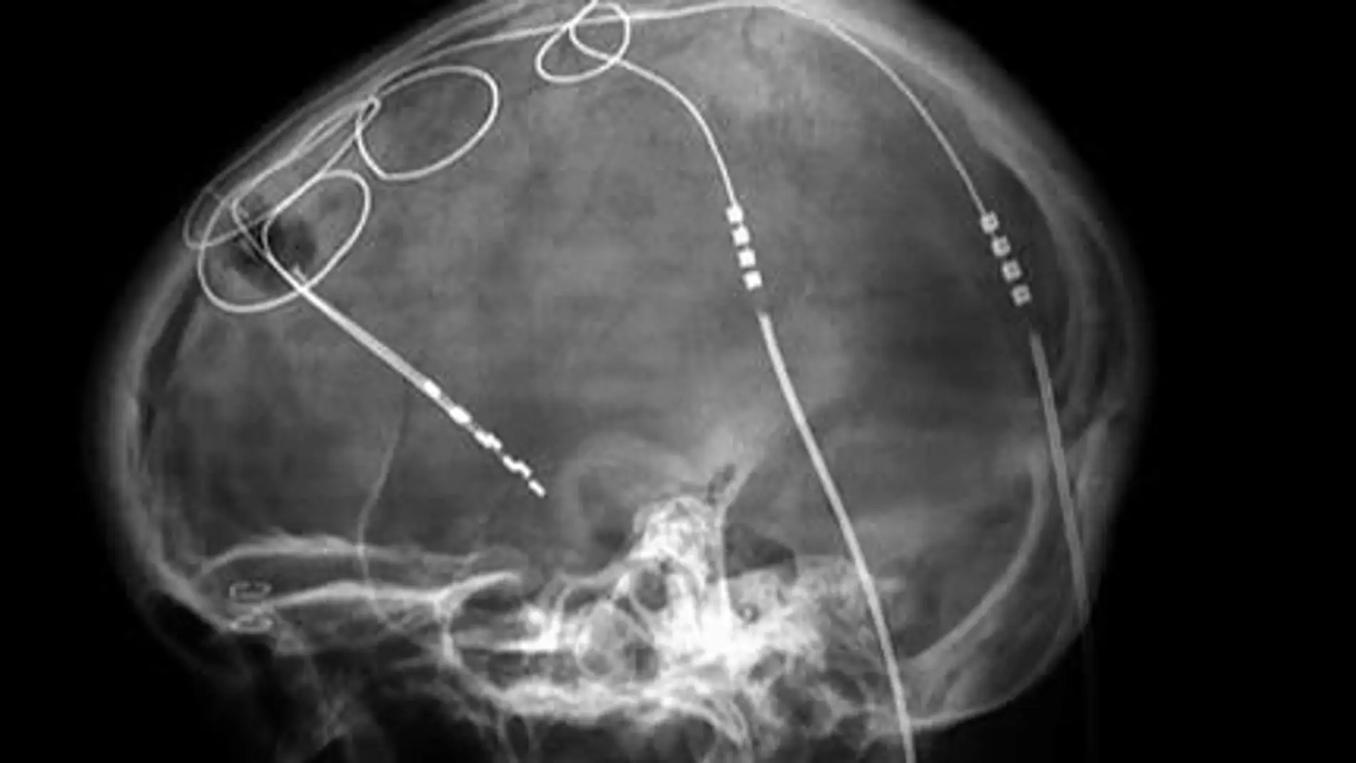 Estimulación cerebral profunda.
