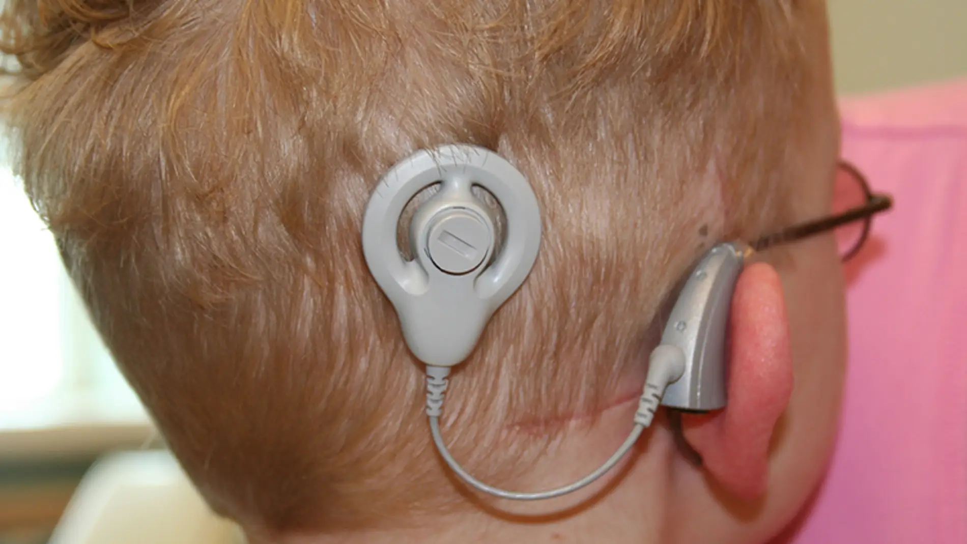 El beneficio de los implantes cocleares