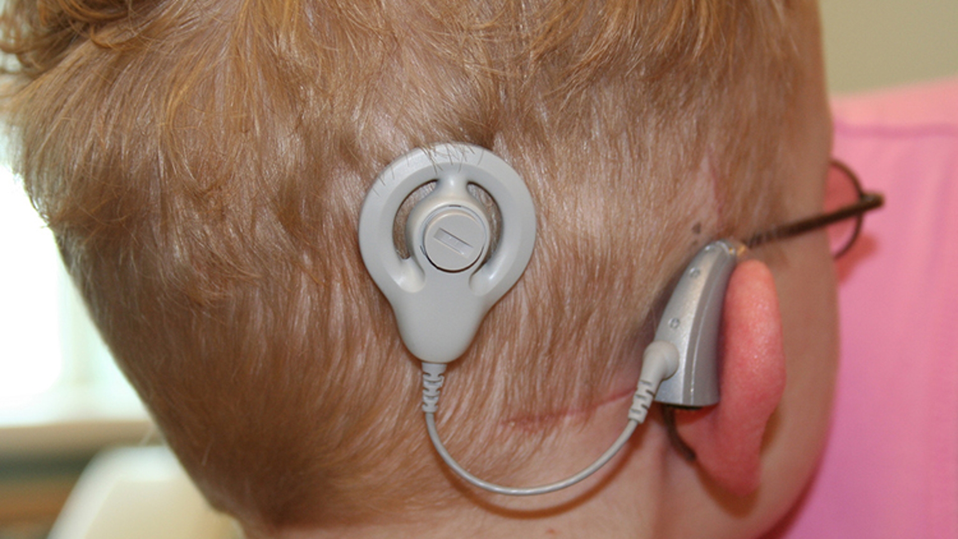El beneficio de los implantes cocleares