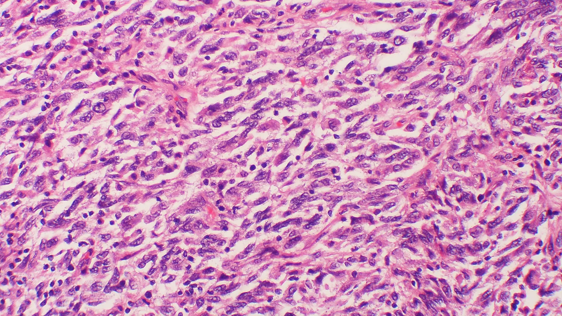 Muestra celular de melanoma con metástas
