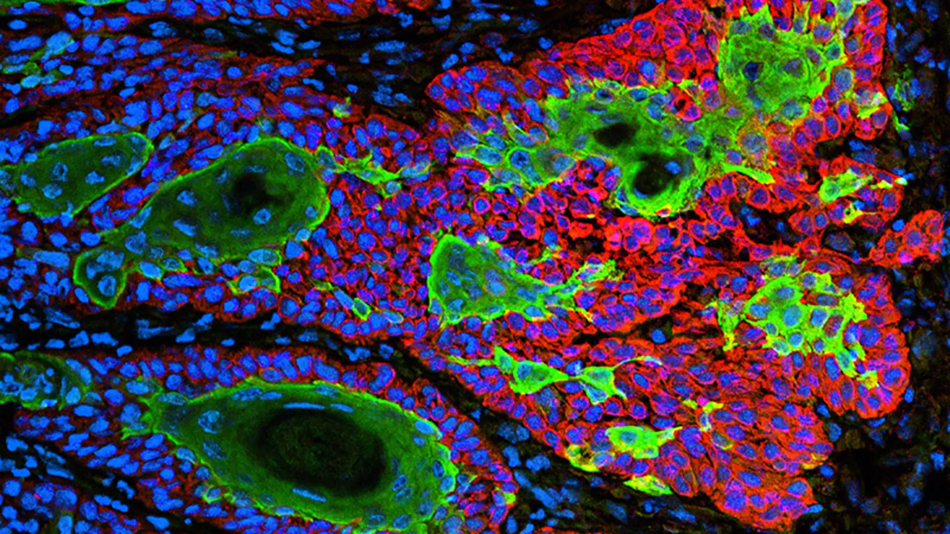 Carcinoma de células escamosas, un tipo