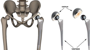 Las prótesis de cadera