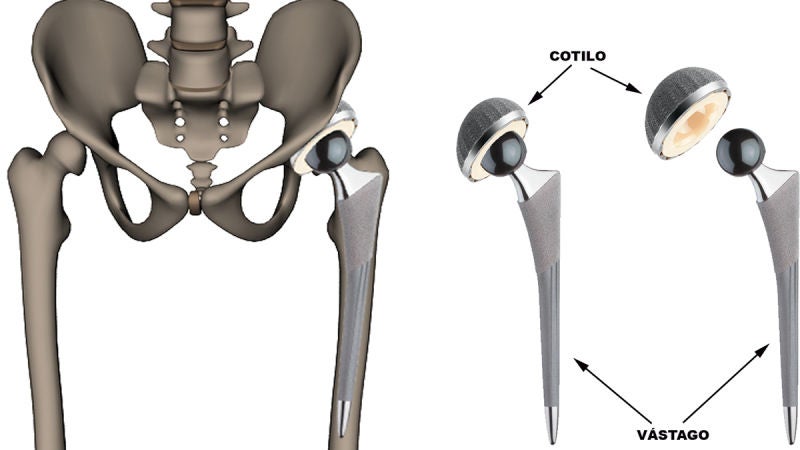 Las prótesis de cadera