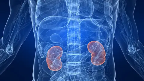 Piedras en el riñón Piedras en el riñón