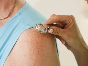 El número de lunares del brazo puede alertar de cáncer de piel El número de lunares del brazo puede alertar de cáncer de piel