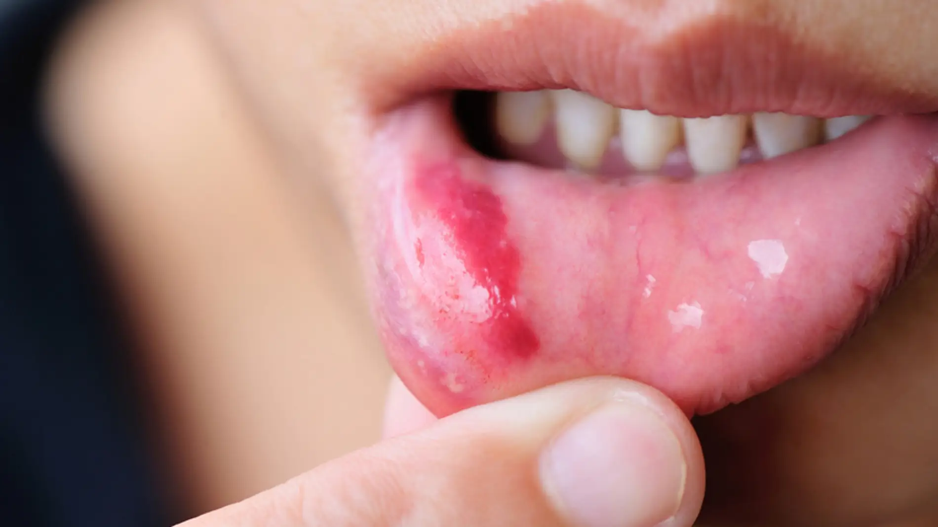 Labio con herpes simple. / Fotolia