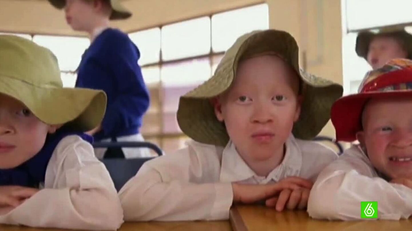 Ni&ntilde;os albinos en &Aacute;frica