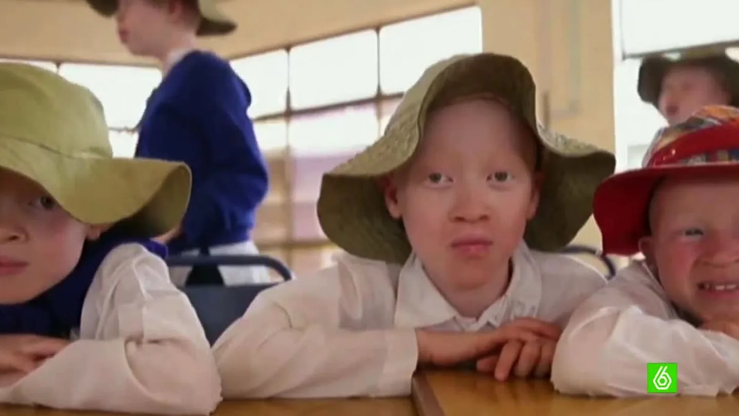 Niños albinos en África Niños albinos en África