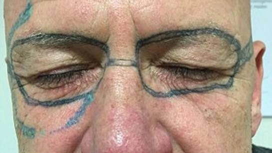 Se tatúa unas gafas de sol en la cara después de una borrachera Se tatúa unas gafas de sol en la cara después de una borrachera